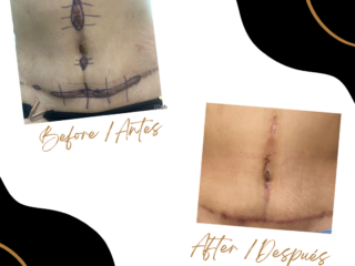 Case 46 - Scar Revision