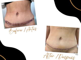 Case 47 - Scar Revision