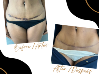 Case 49 - Scar Revision