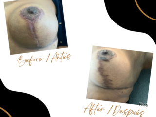 Case 50 - Scar Revision